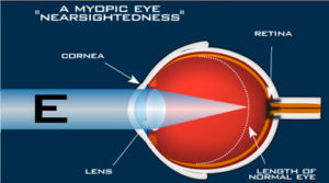 New York Myopia Control
